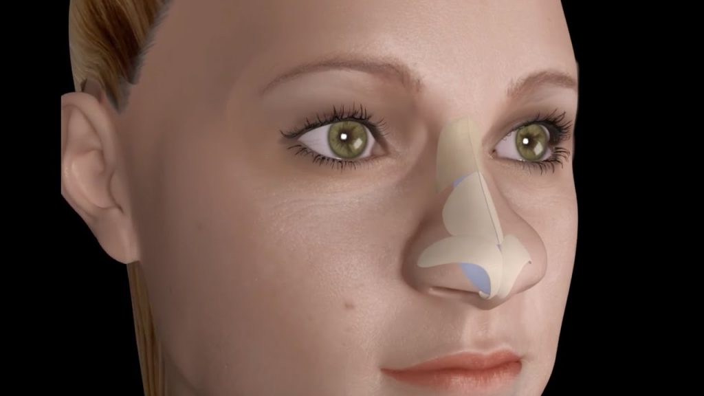 7 Things I Wish I Knew Before I Got Nose Job/ Rhinoplasty