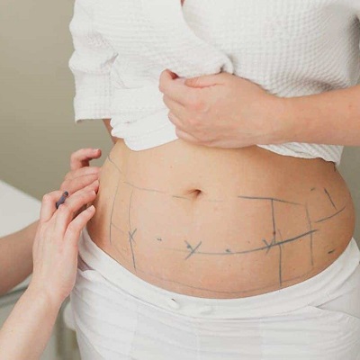 Best Liposuction Surgery in Dubai