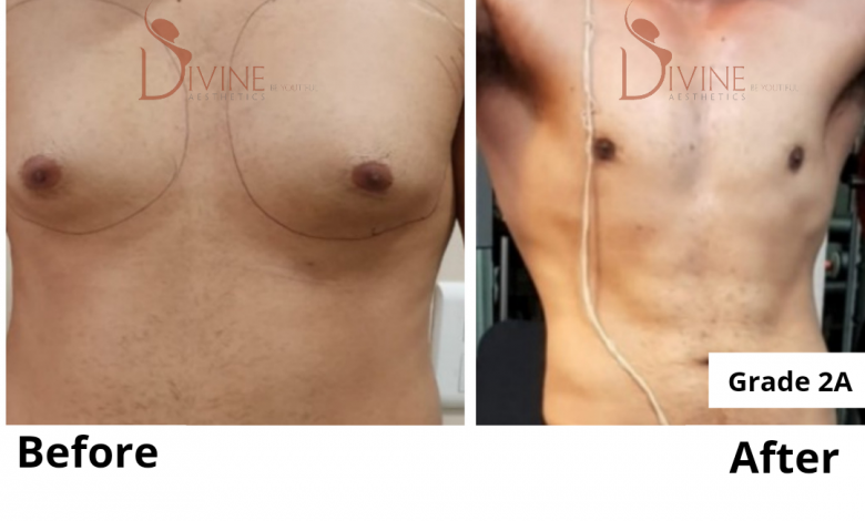 gynecomastia surgery