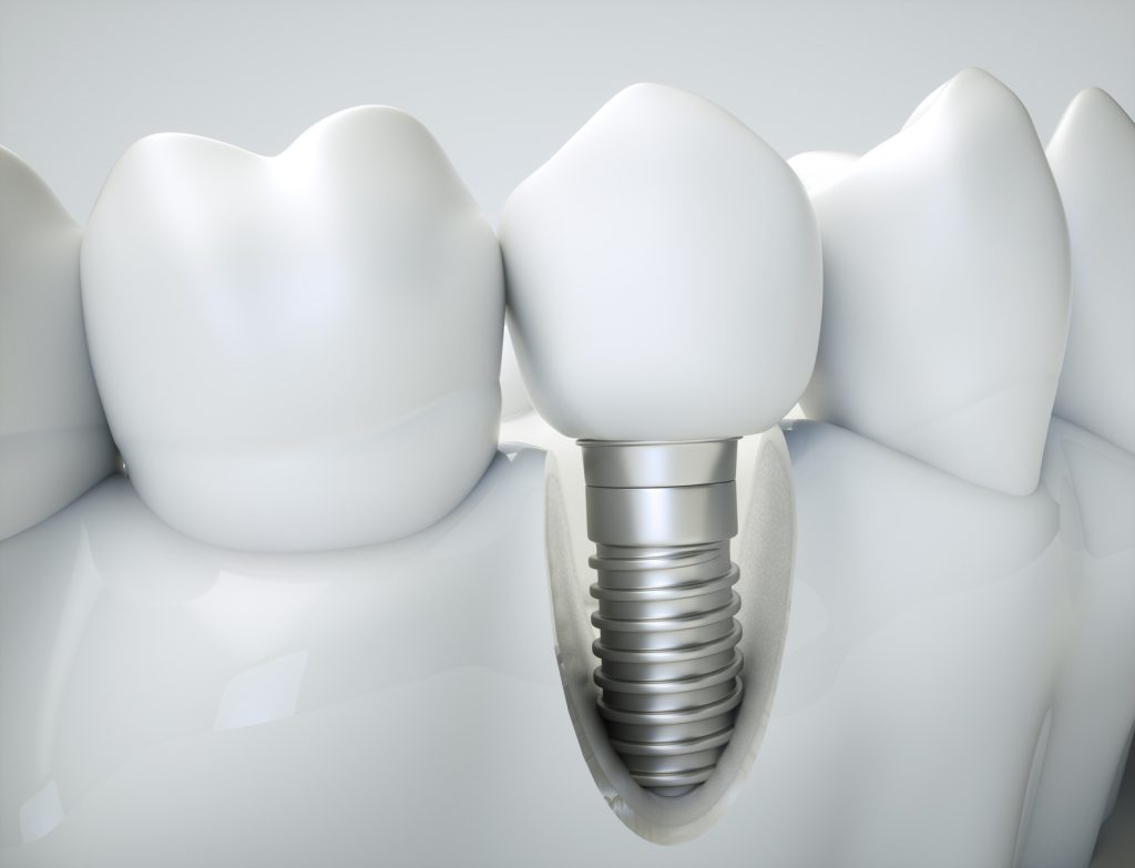 How to care for dental implants