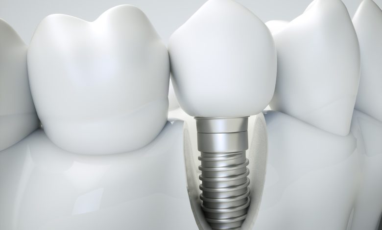 How to care for dental implants