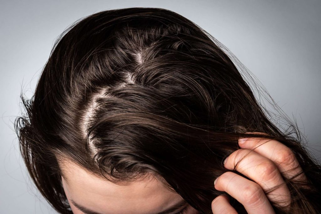 best medicated AntiDandruff lotion