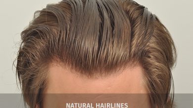 natural hairline- A Natural Hairline Back with FUE Hair Transplant