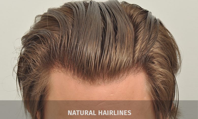 natural hairline- A Natural Hairline Back with FUE Hair Transplant