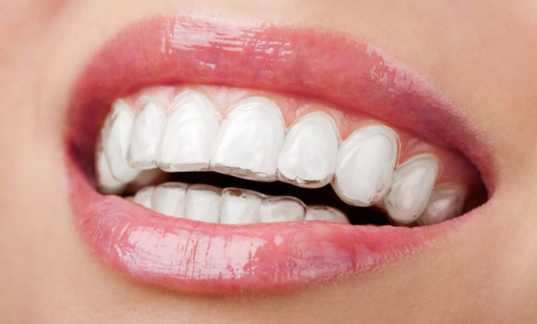 invisalign provider