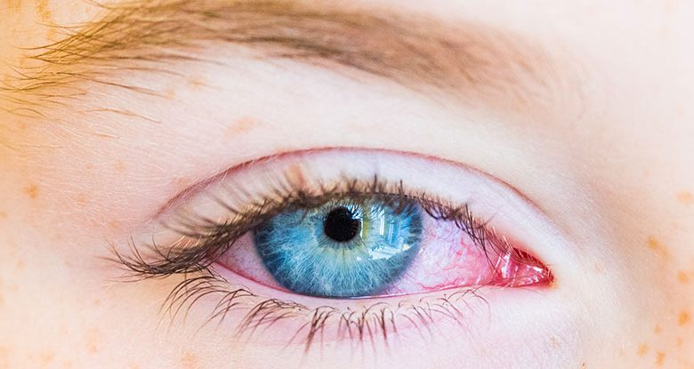 Conjunctivitis - Featured Image