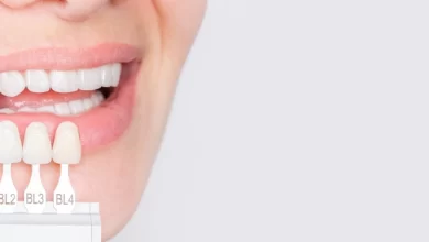 Dental Veneers in Dubai