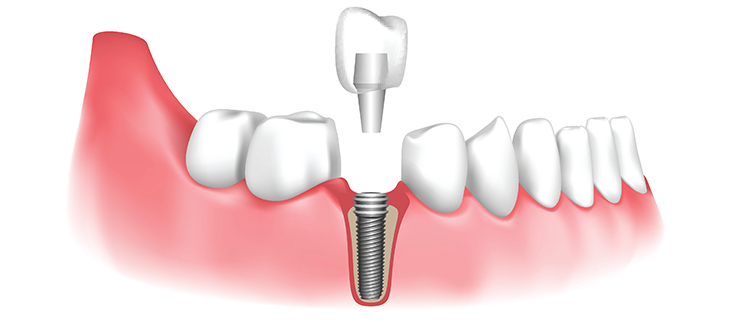 Dental Implants in Dubai