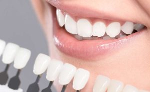 dental veneer services