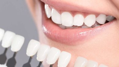 dental veneer services